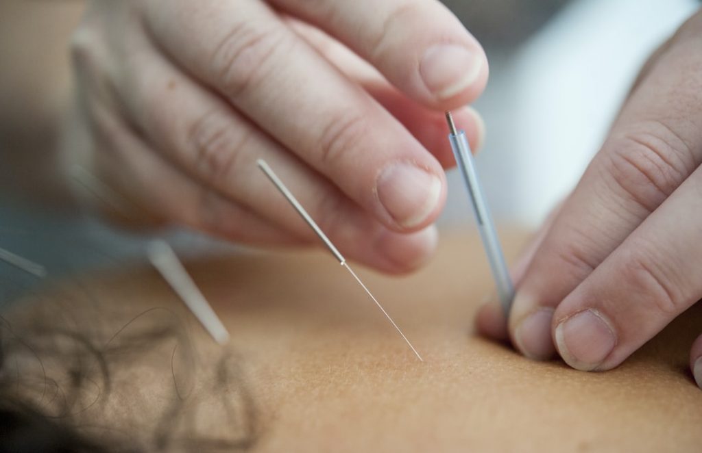 Osteopath from Balanced Motion Clinic using dry needling-acupuncture technique on a patient for neck pain and sports injury relief, Poole.